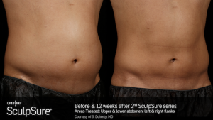 sculpsure mckinney