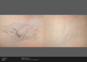 Luxe Laser Hair Removal Austin Texas