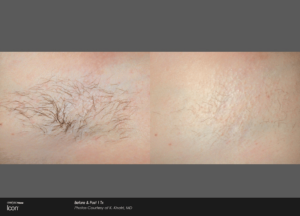 Laser Hair Removal North Dallas Cernero Surgery & Aesthetics