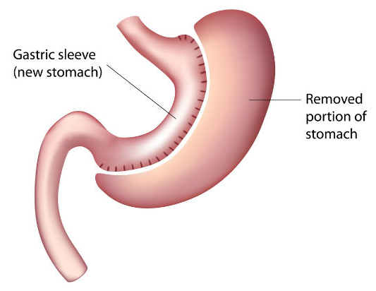 what is gastric sleeve