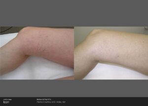 Scar Treatment