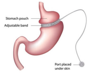 Lap-band