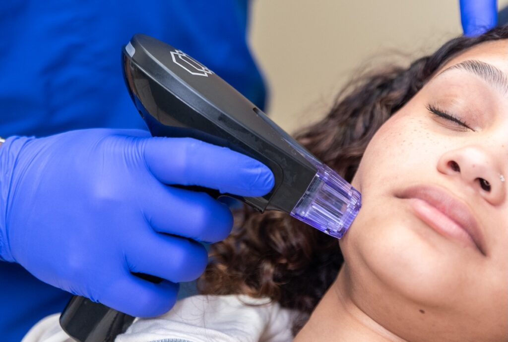 A close up of Dr. Cernero gliding the Morpheus8 handpiece across a female patient's lower cheek for a nonsurgical facelift near Dallas.