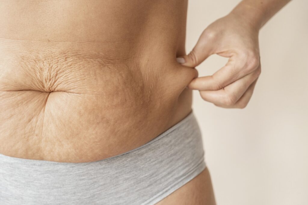 A woman pinches her loose skin, reflecting the need for RF skin tightening in Durant at Cernero Surgery & Aesthetics.